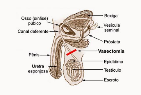 Vasectomia: mitos e verdades