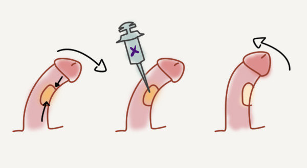 O que é a doença de Peyronie